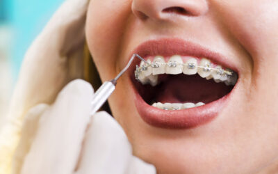 Denti sani e dritti grazie alla ortodonzia