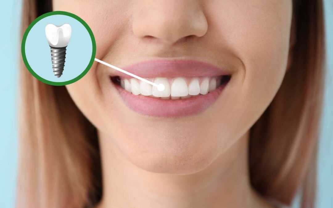 Torna a sorridere con gli impianti dentali