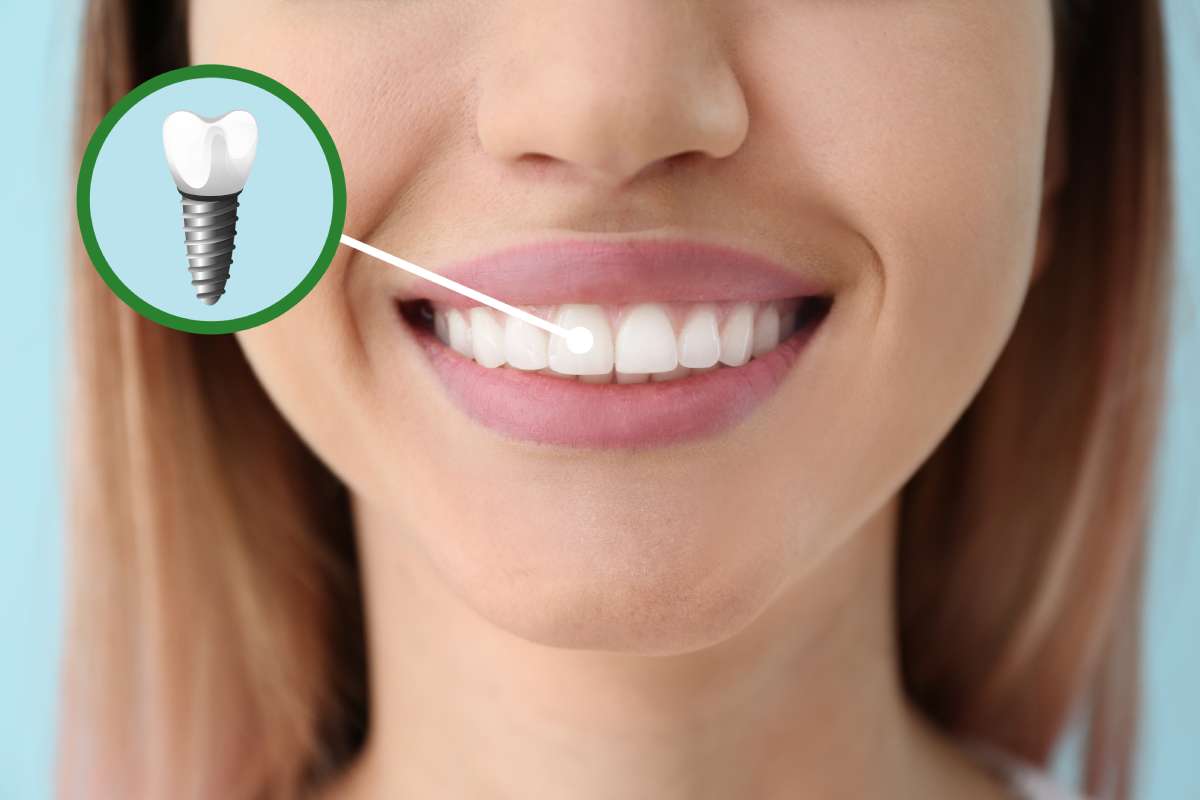 Torna a sorridere con gli impianti dentali