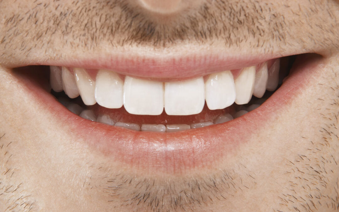 Faccette dentali per rinnovare l’estetica del sorriso