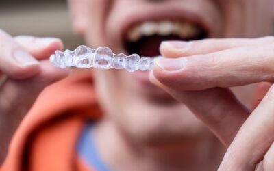 Tutti i vantaggi degli allineatori dentali trasparenti