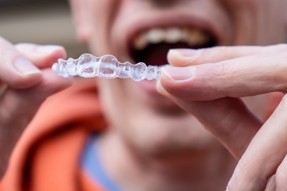 allineatore dentale trasparente tenuto fra le mani da un uomo che sorride