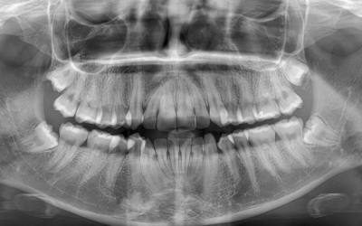 Denti del giudizio: tutto quello che devi sapere