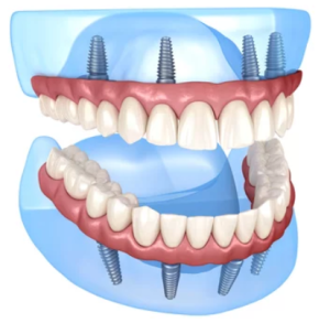 Protesi fissa su impianti dentali superiori e inferiori con 6 impianti per arcata