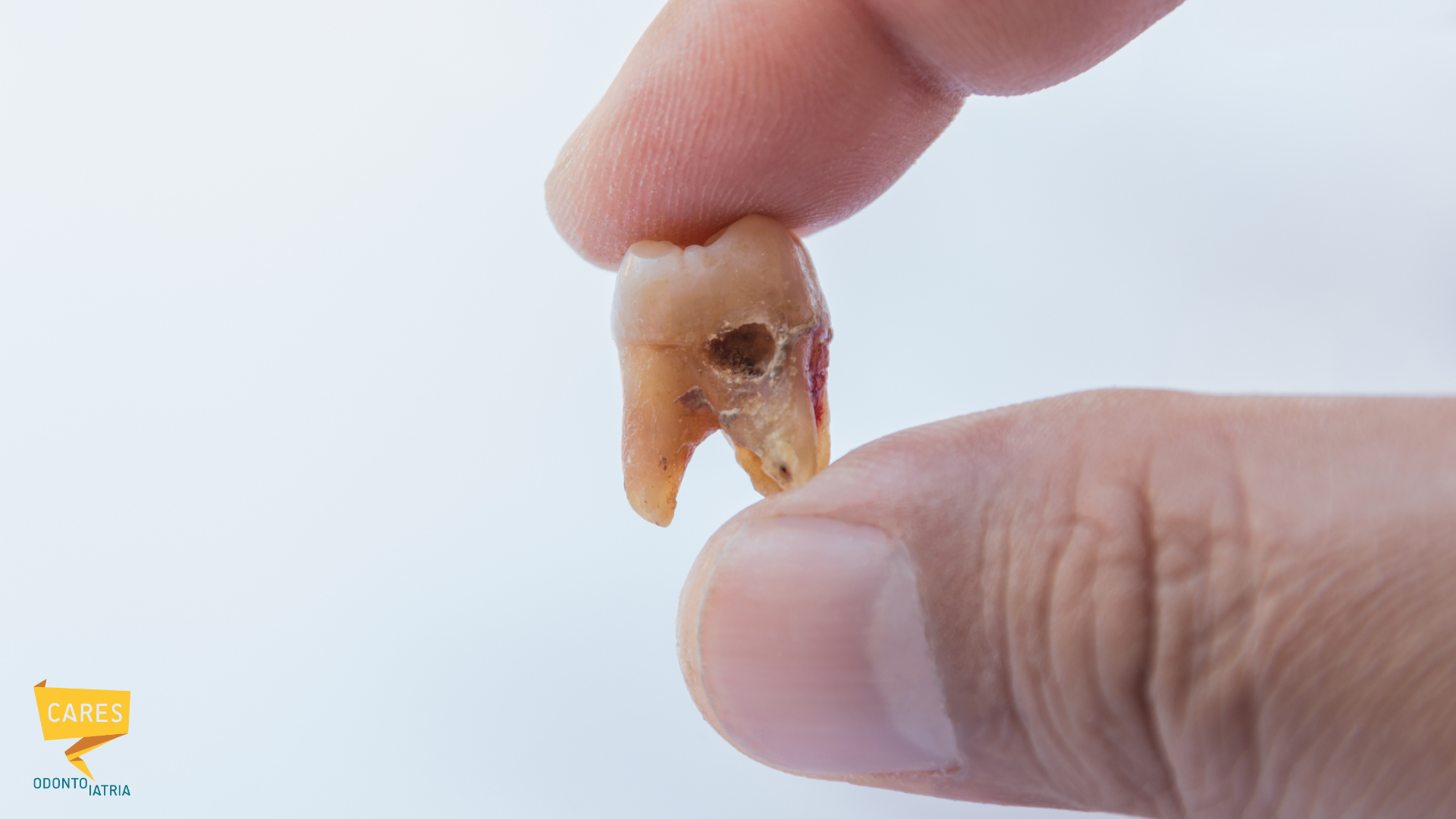 Dente estratto con carie avanzata e foro di infezione visibile - Cares Odontoiatria Cagliari
