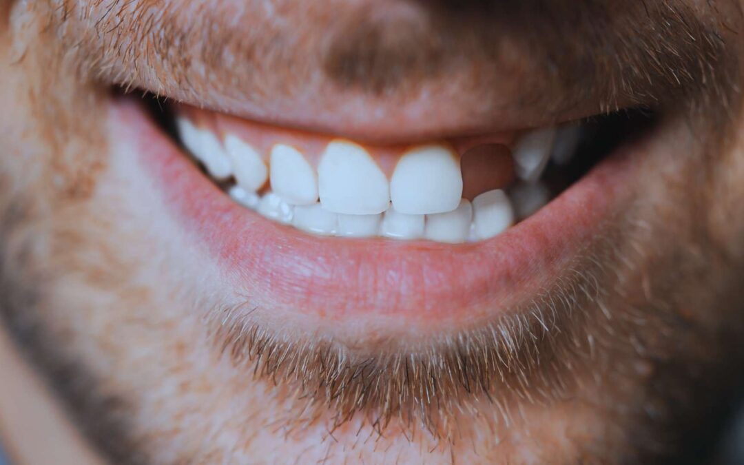 Dente mancante: cosa succede se non lo sostituisco?