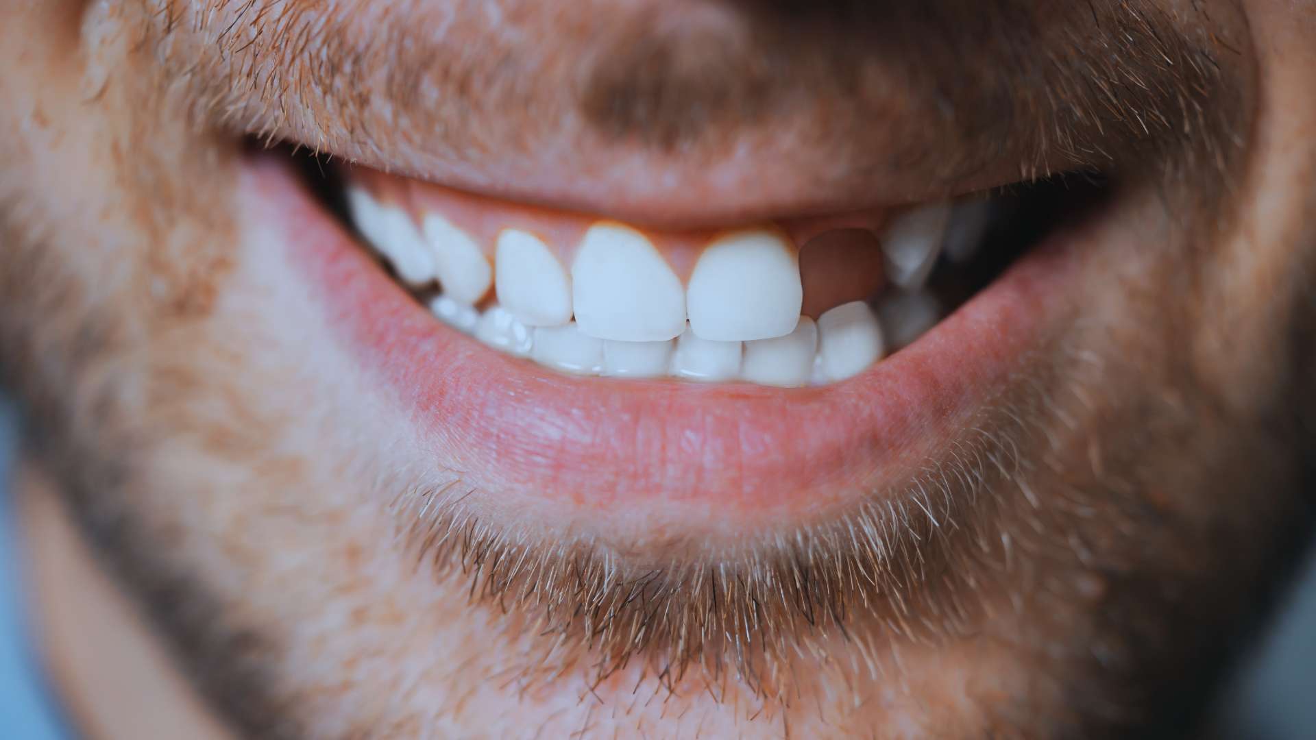 Sorriso maschile con dente mancante: esempio clinico di sostituzione dentale e riabilitazione protesica CARES Odontoiatria.