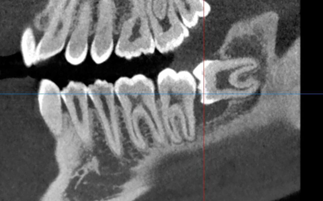 Denti del giudizio: rischi, soluzioni moderne e recupero