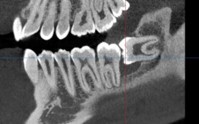 Denti del giudizio: rischi, soluzioni moderne e recupero