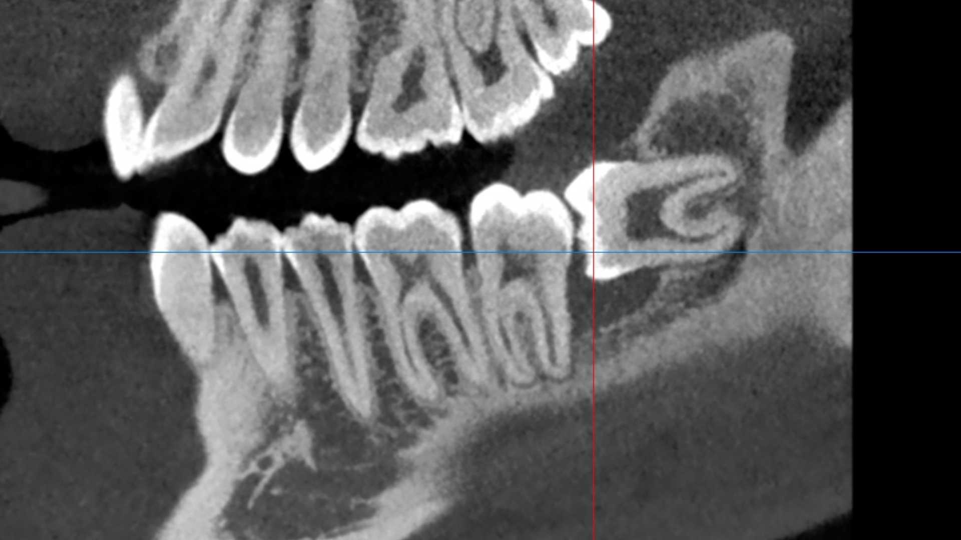 Radiografia TAC 3D di un dente del giudizio incluso e inclinato che spinge sui denti vicini – Cares Odontoiatria Uta Cagliari