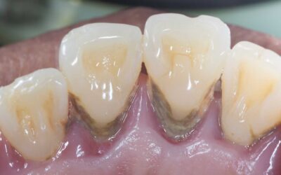 Parodontite grave: fermare la piorrea e salvare il sorriso