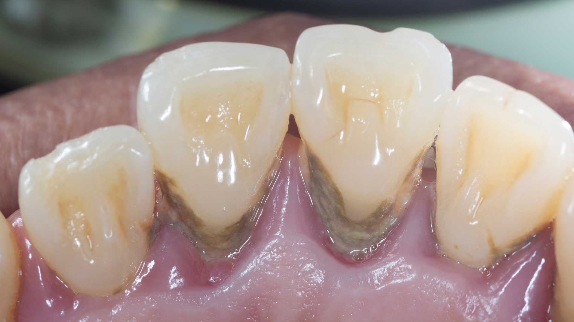 Denti con tartaro e gengive infiammate, segno di parodontite grave.