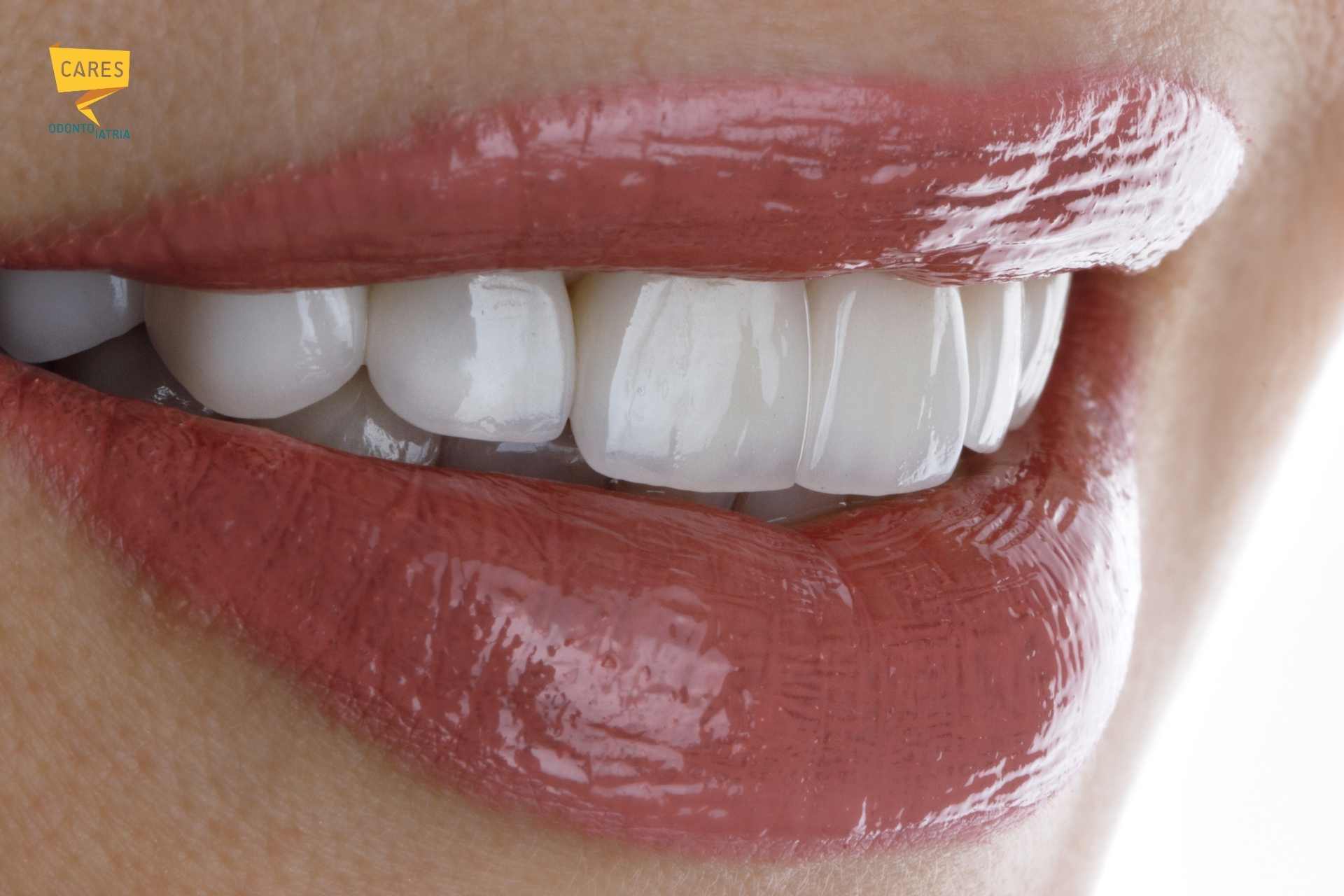 Sorriso con faccette dentali estetiche realizzate da Cares Odontoiatria Uta, vicino a Decimomannu.