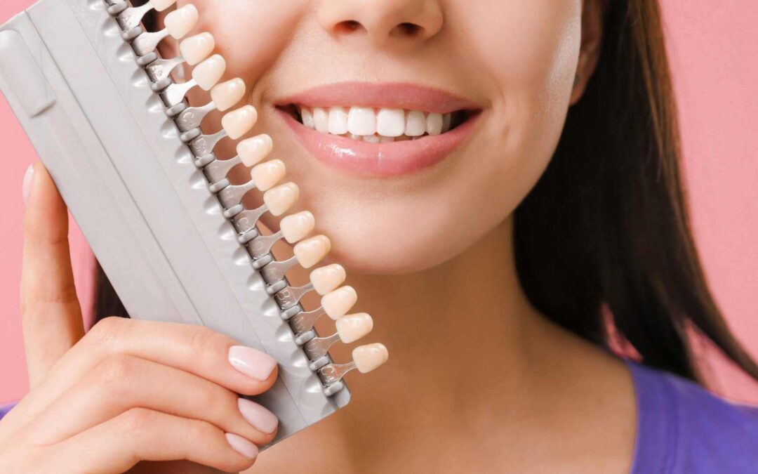 Le faccette dentali rovinano i denti? Ecco la risposta