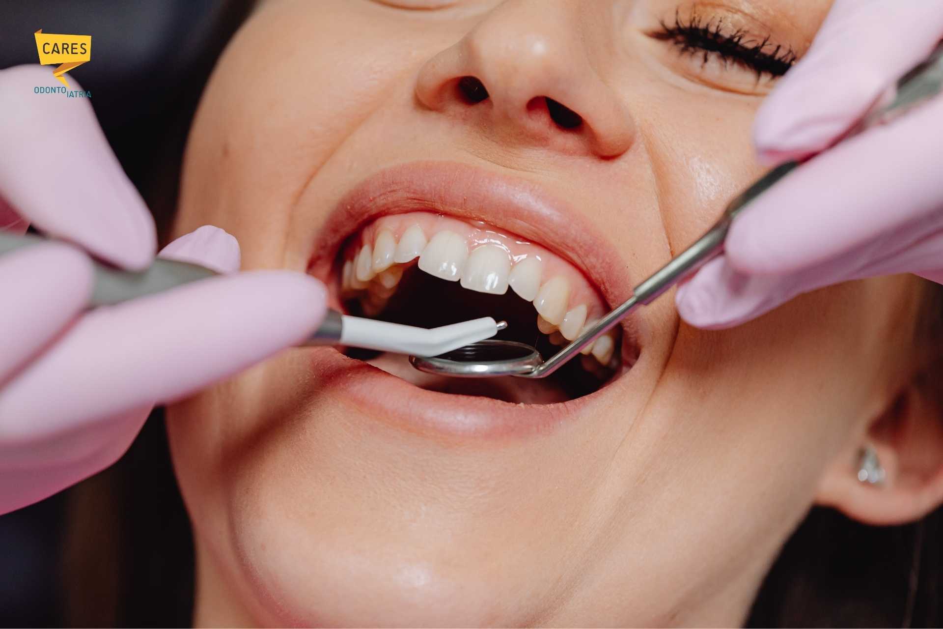 Trattamento di igiene dentale professionale e sbiancamento presso Cares Odontoiatria Uta, vicino a Decimomannu