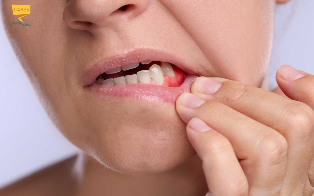 Gengive infiammate: cause, sintomi e rimedi per un sorriso sano