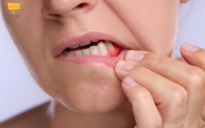 Gengive infiammate: cause, sintomi e rimedi per un sorriso sano