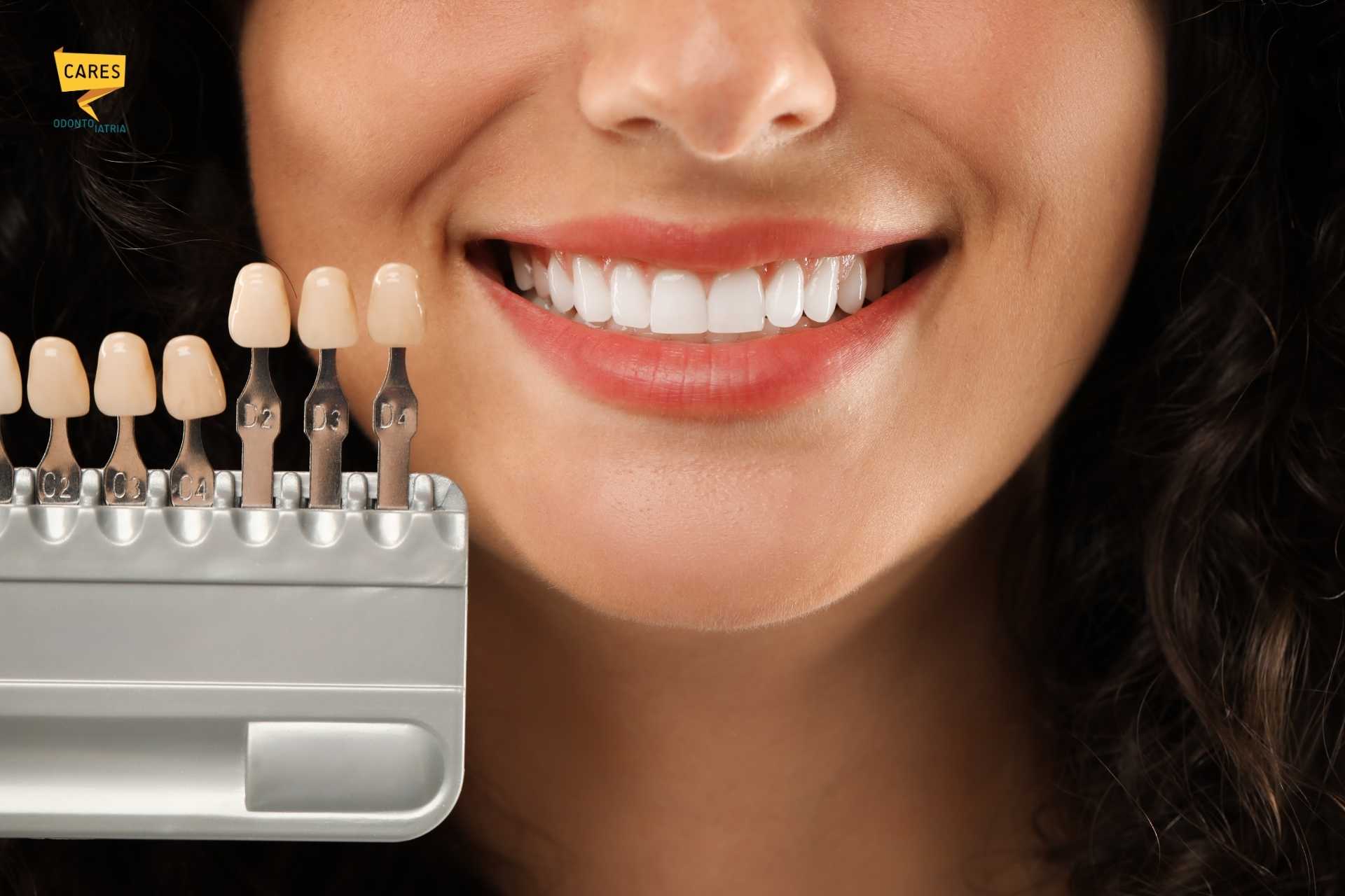 Dettaglio di un sorriso con guida colori per faccette dentali presso Cares Odontoiatria Uta, vicino a Villasor