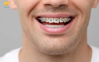 Denti storti: Come raddrizzare i denti in età adulta?