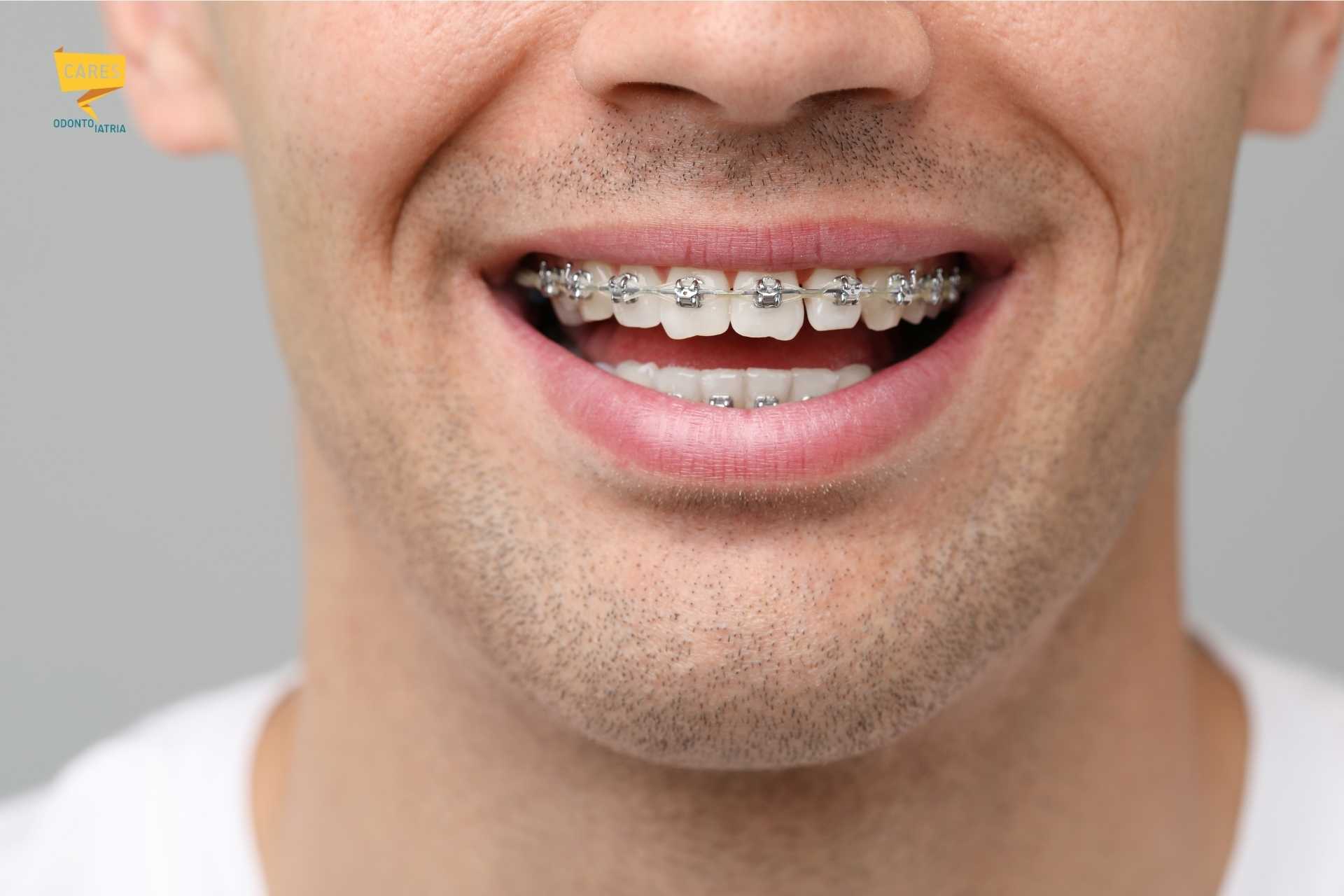 Apparecchio fisso per adulti – raddrizzare i denti storti Sorriso di uomo adulto con apparecchio fisso ai denti per correggere denti storti