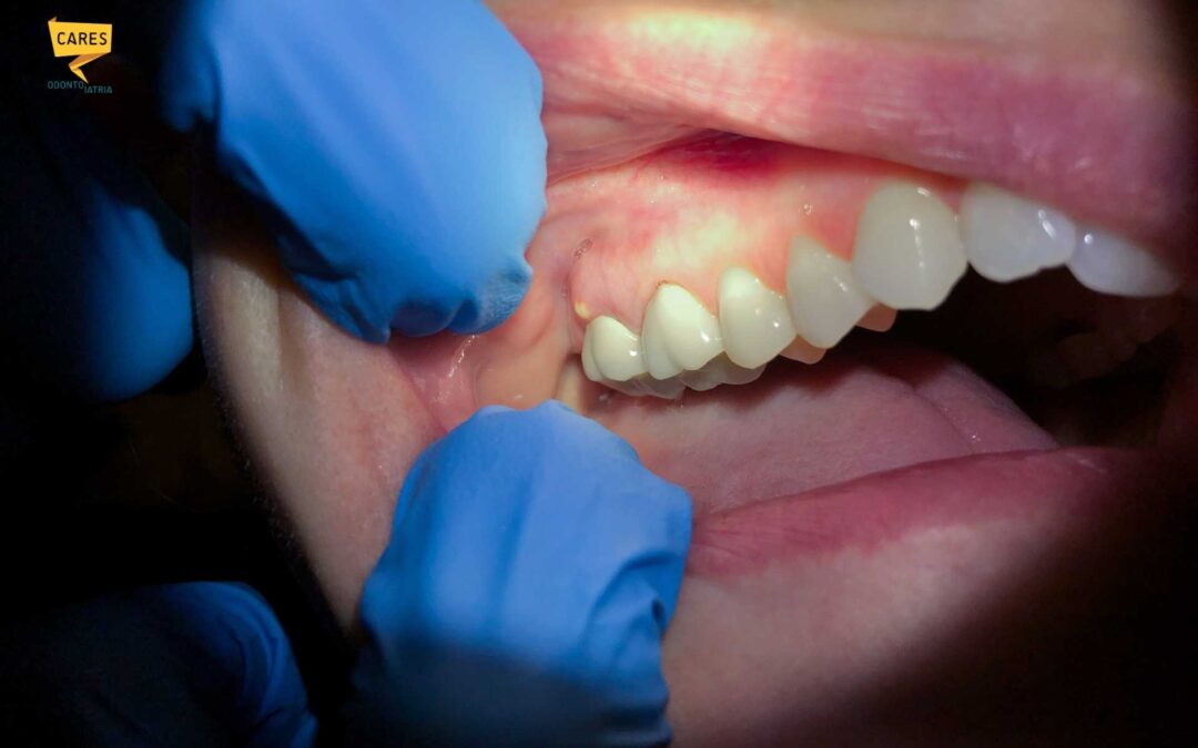 Ascesso dentale: quando diventa pericoloso e come curarlo