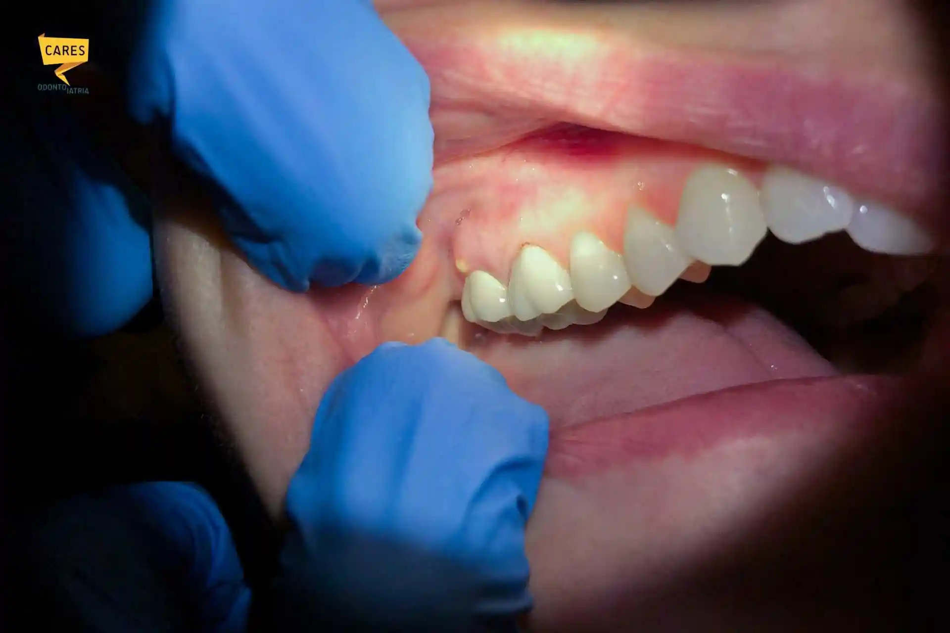 Primo piano di un ascesso dentale sulla gengiva, esaminato dal dentista con guanti blu durante una visita odontoiatrica