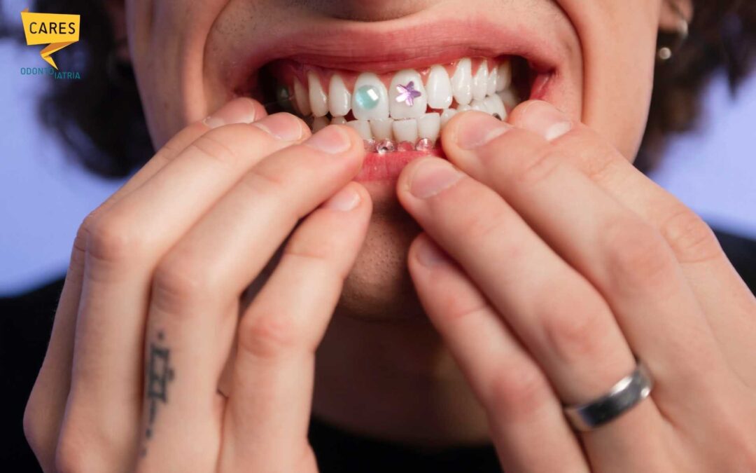 Grillz e sorrisi social: moda o rischio per i denti? | CARES