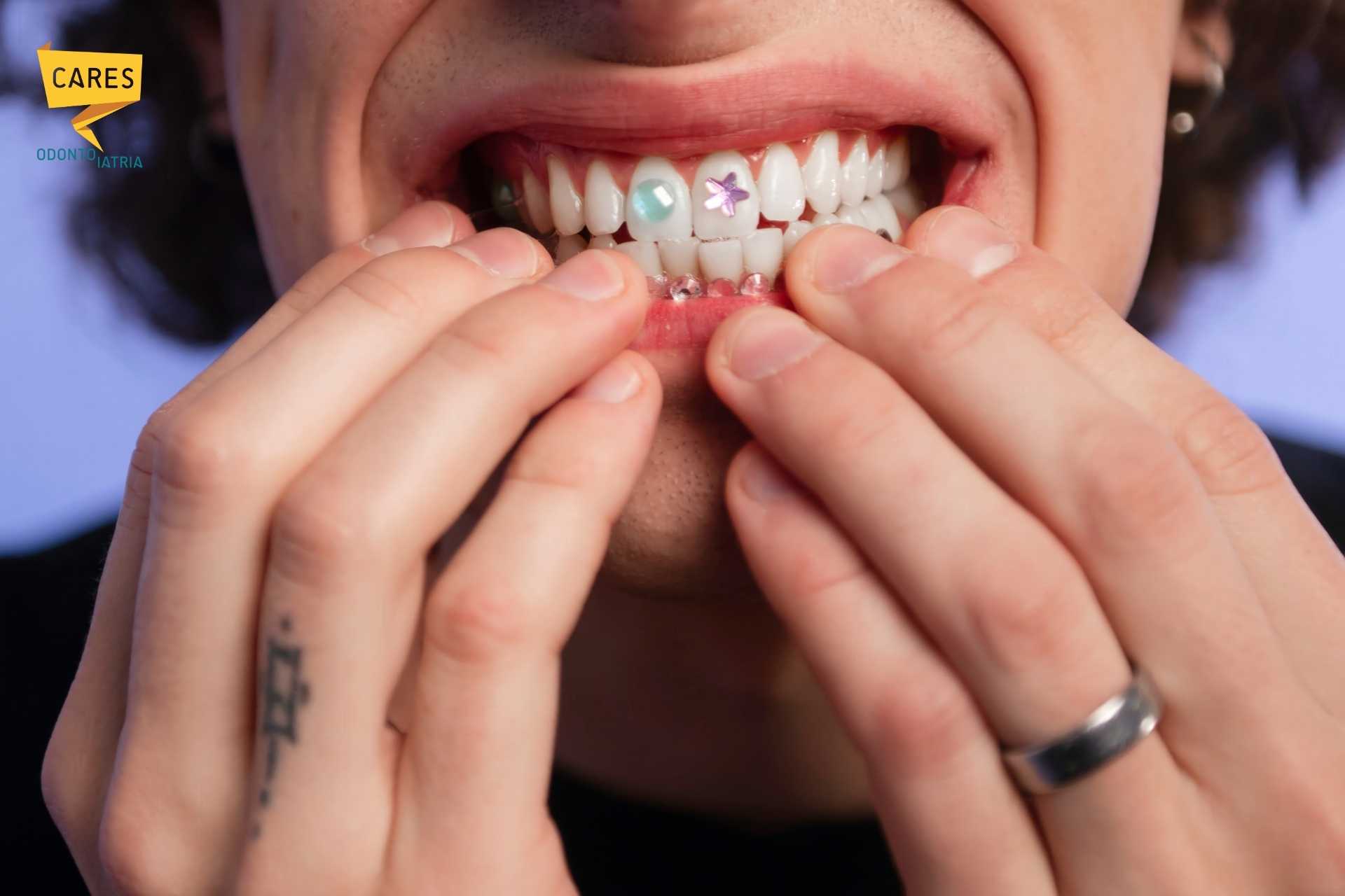 Grillz e brillantini sui denti: la nuova moda tra i ragazzi Giovane con grillz e brillantini sui denti che mostra il sorriso, simbolo delle nuove mode social tra gli adolescenti