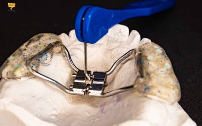 Palato ogivale: cos’è, cause nei bambini e come si corregge