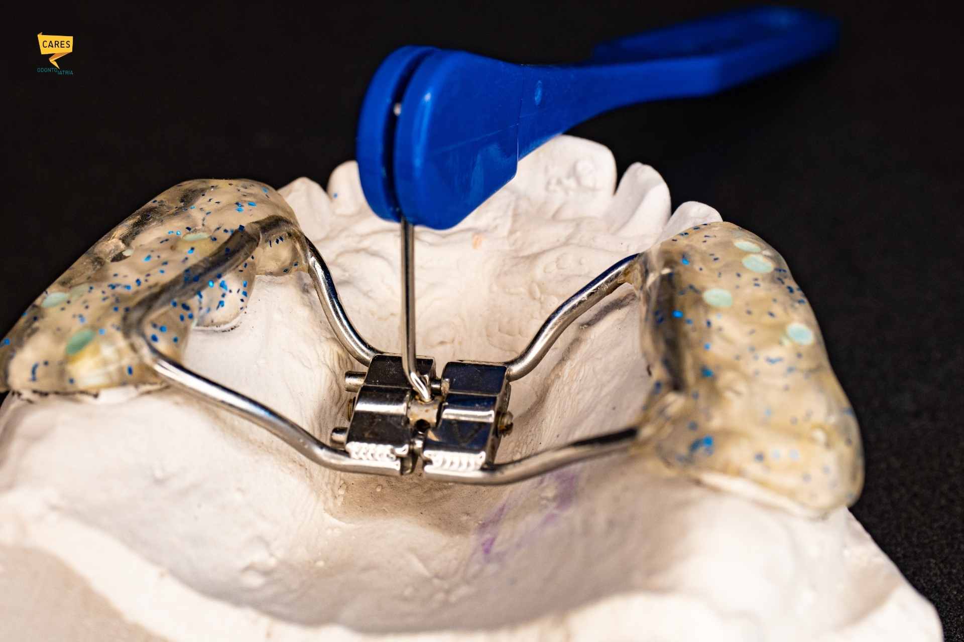 Espansore palatale applicato su modello dentale per il trattamento del palato ogivale e del palato stretto in età pediatrica