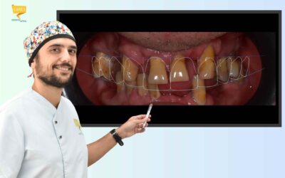 Progettazione impianto dentale: durata, estetica, comfort