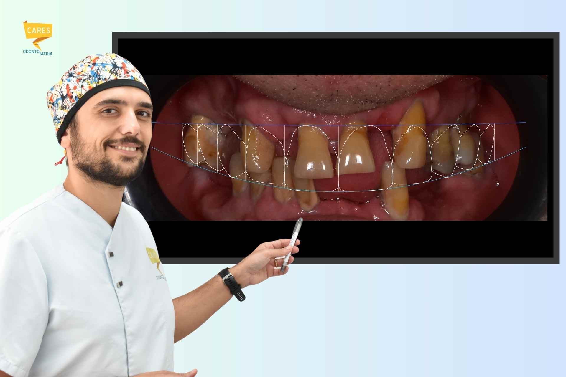 Progettazione impianto dentale con scanner 3D e Digital Smile Design per una riabilitazione precisa, estetica e senza dolore