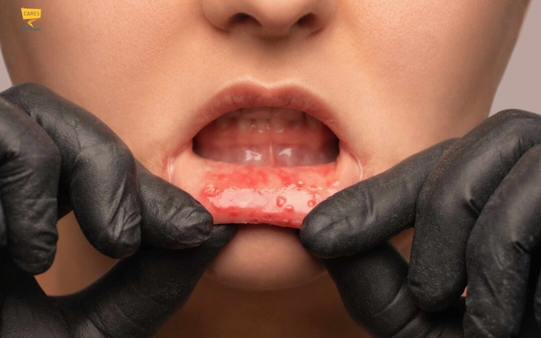 Afta: quanto tempo ci vuole per guarire e come curarla