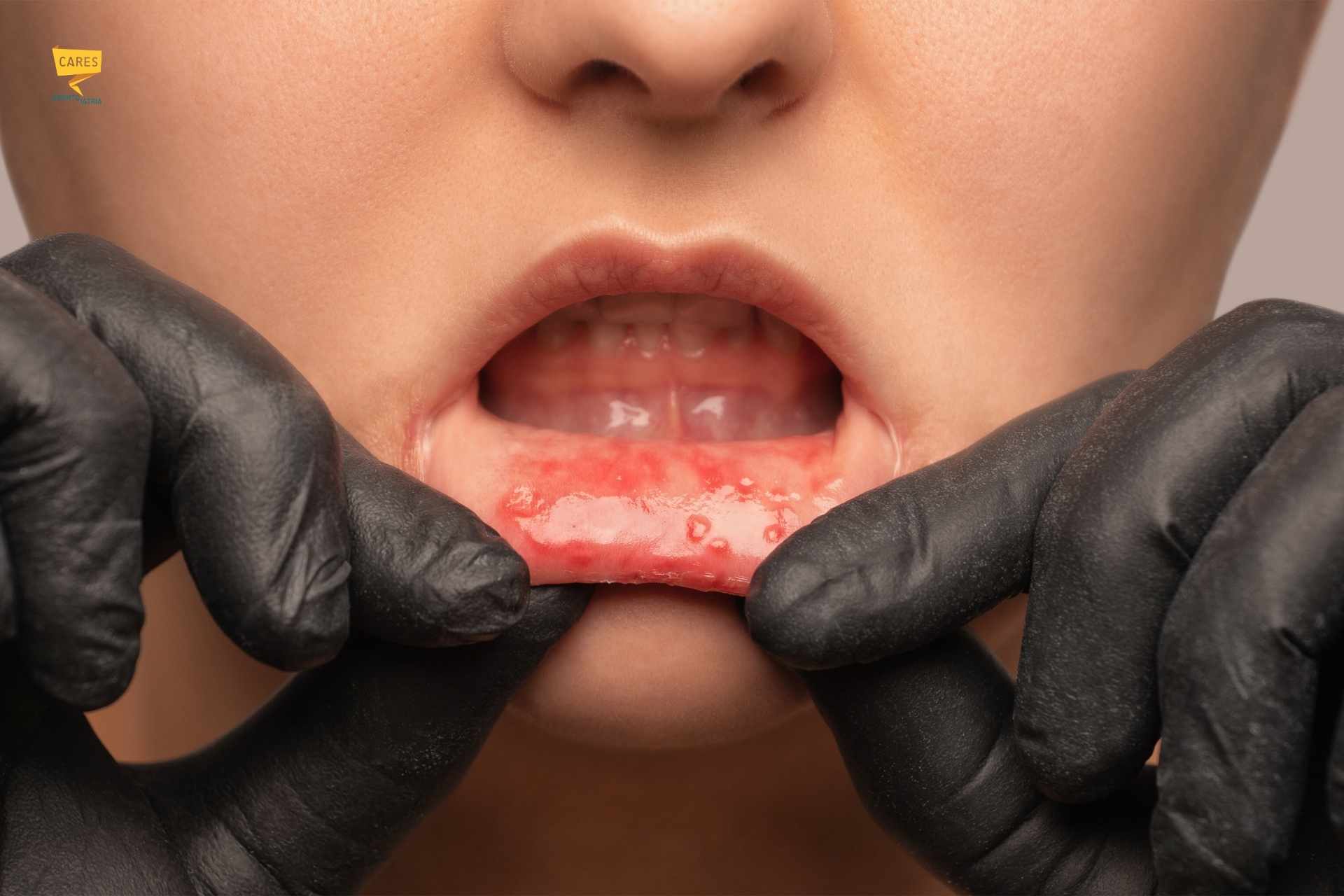 Afta in bocca: come si presenta e quanto dura