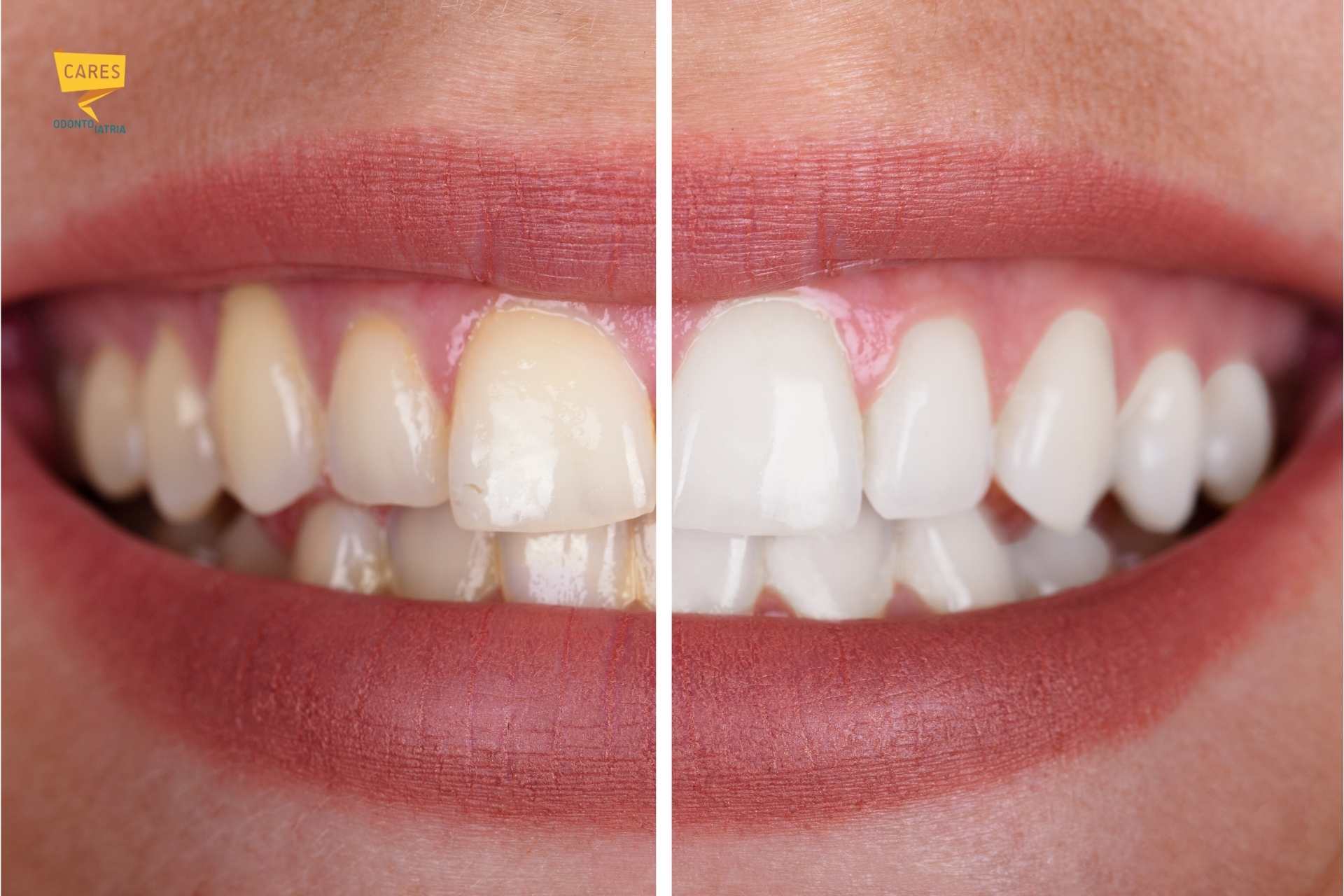 Sbiancamento dentale professionale: risultato prima e dopo il trattamento Sbiancamento dentale professionale prima e dopo: confronto del sorriso prima e dopo il trattamento eseguito dal dentista