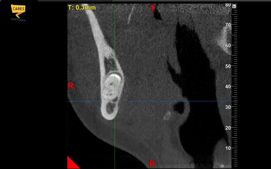 Estrazione dente del giudizio: perché la TAC è fondamentale