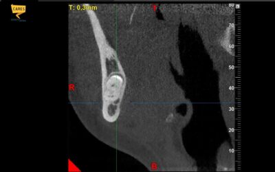 Estrazione dente del giudizio: perché la TAC è fondamentale