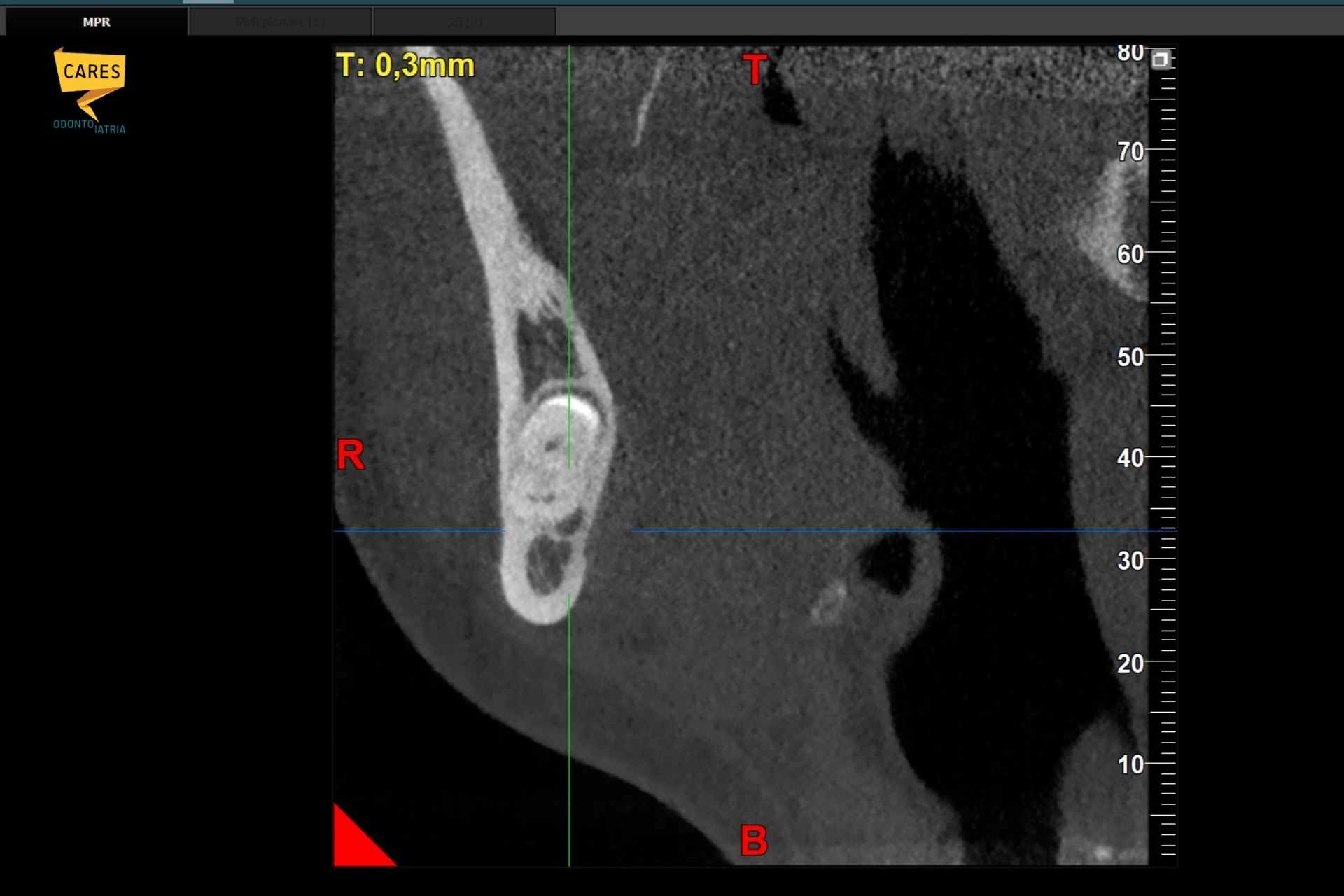 TAC 3D del dente del giudizio: analisi del rapporto con il nervo TAC 3D che mostra il dente del giudizio inferiore e la posizione del nervo alveolare prima dell’estrazione