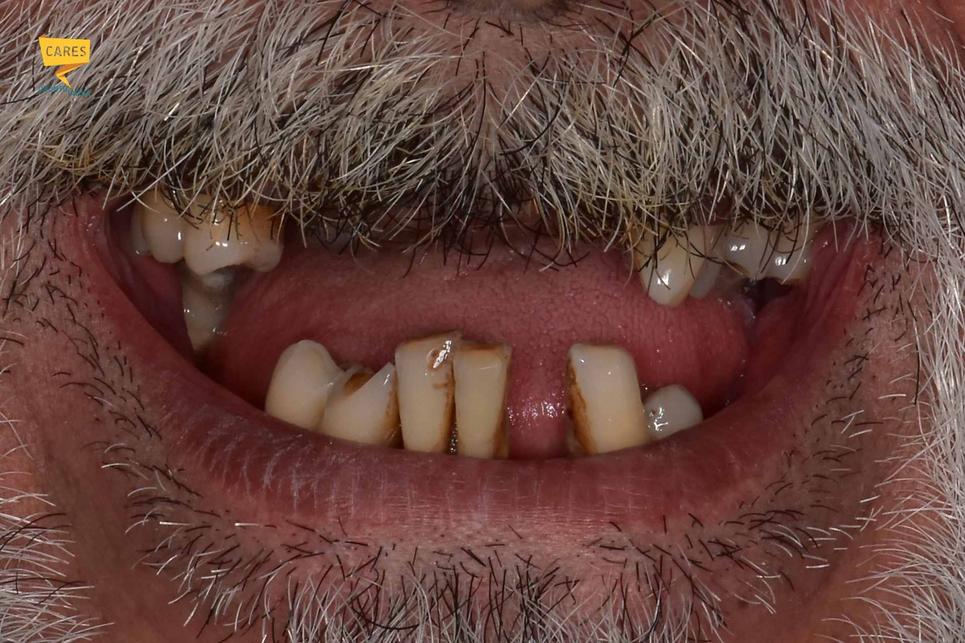 Sorriso dopo riabilitazione completa della bocca seguita nel tempo da CARES Odontoiatria