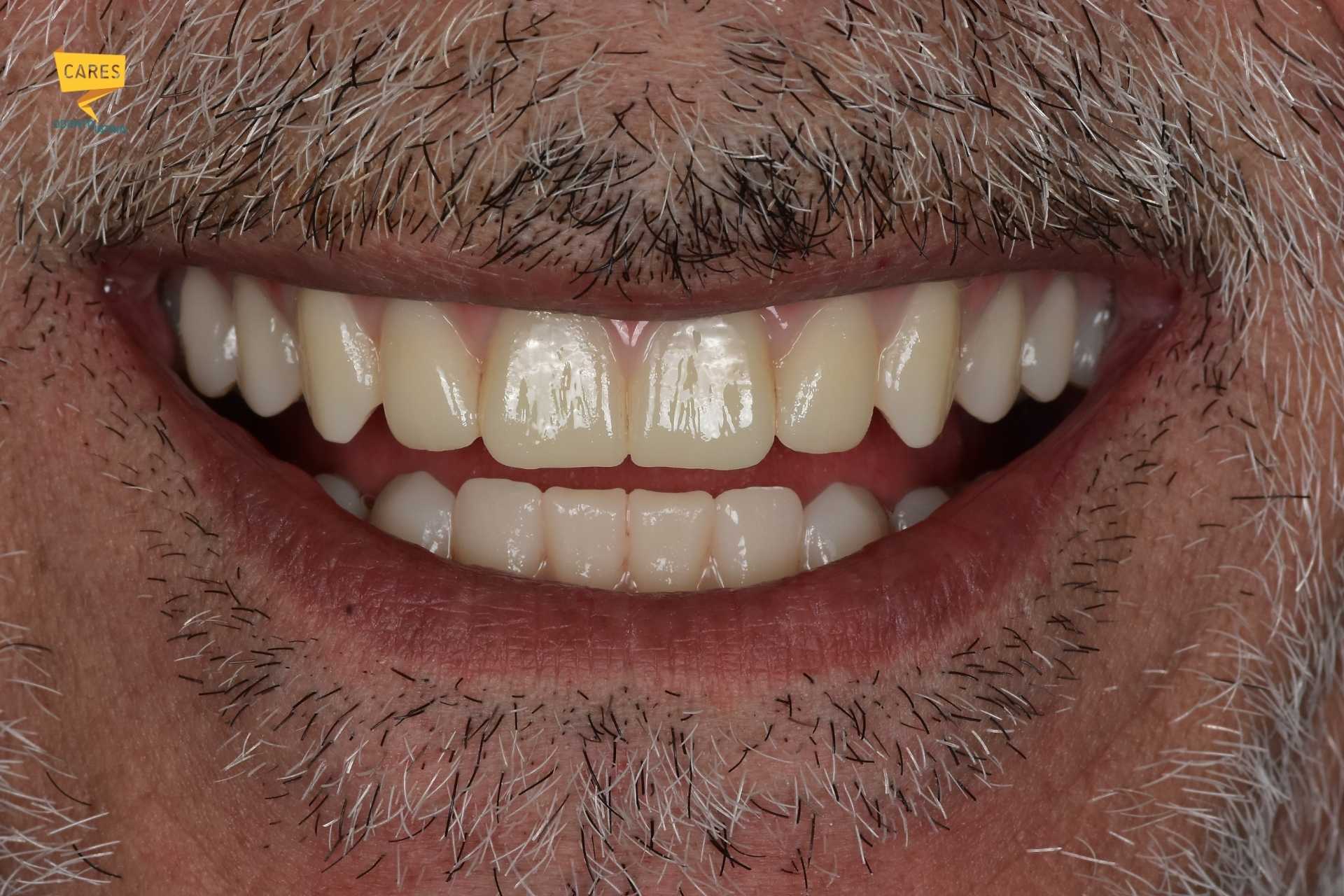 Sorriso dopo riabilitazione completa della bocca seguita nel tempo da CARES Odontoiatria