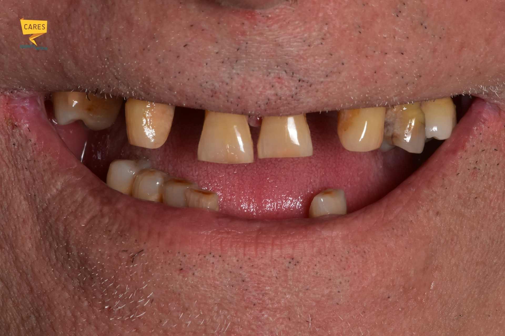 Sorriso finale dopo riabilitazione completa della bocca seguita nel tempo