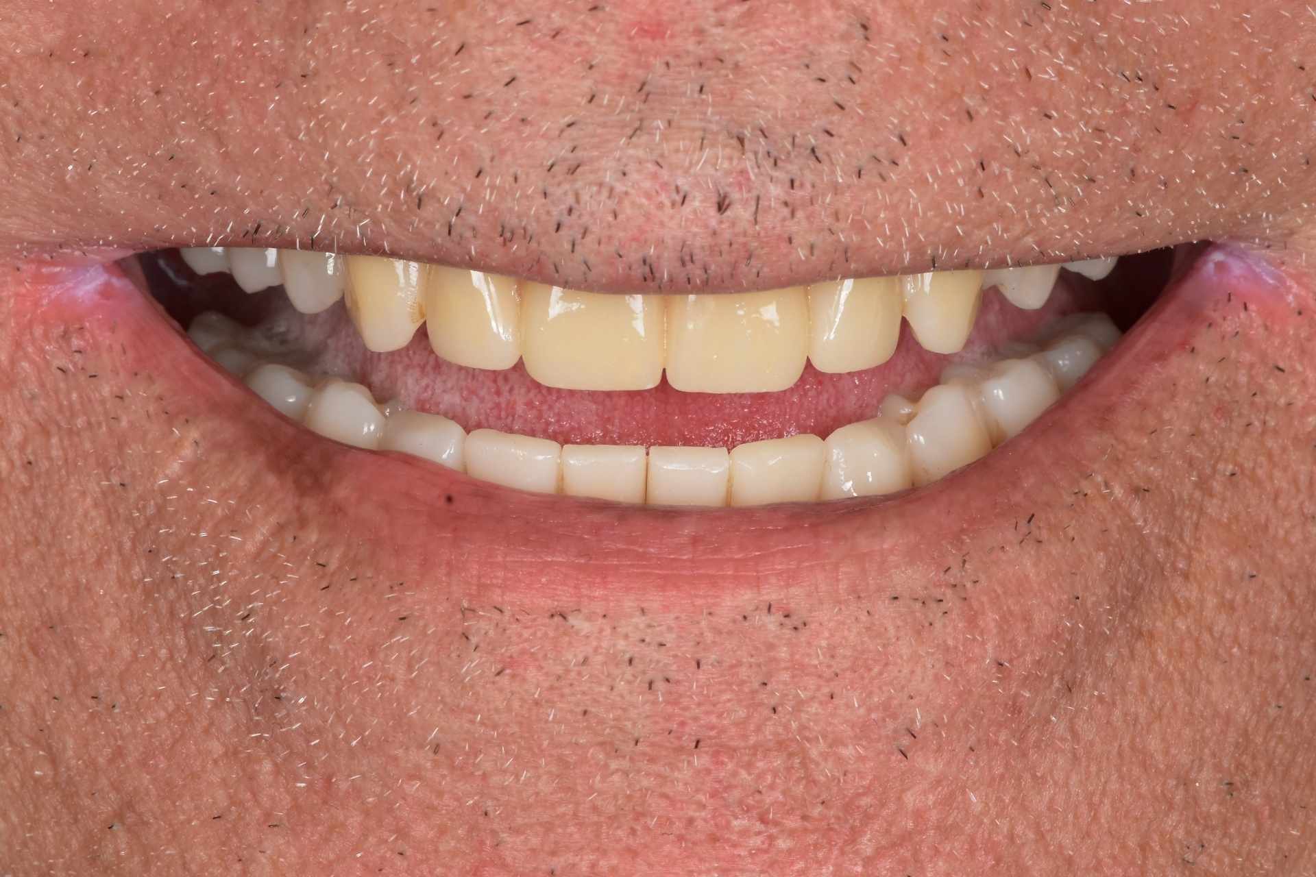 Sorriso finale dopo riabilitazione completa della bocca seguita nel tempo