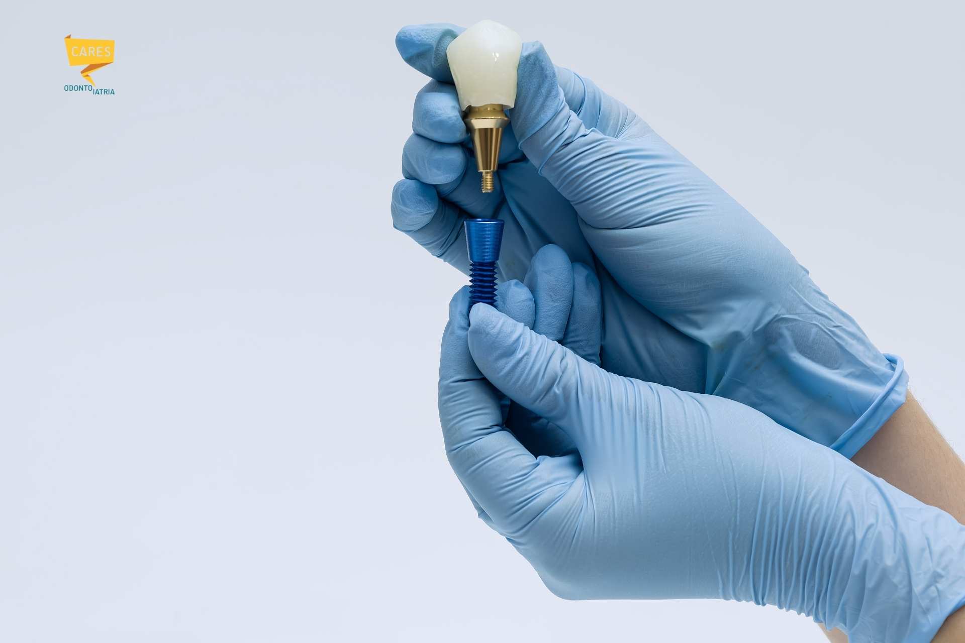 Chirurgia guidata: impianto dentale e componente protesica tenuti da mani con guanti durante una procedura di implantologia dentale