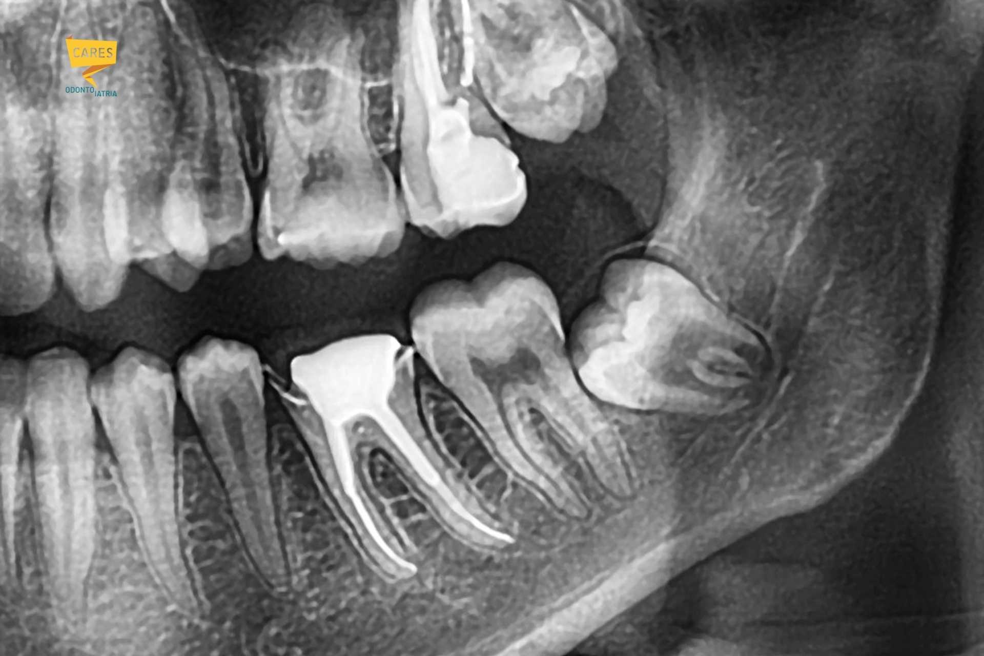 Dente del giudizio incluso in radiografia panoramica Radiografia dentale che mostra un dente del giudizio inferiore incluso in posizione orizzontale vicino al secondo molare e al nervo mandibolare.