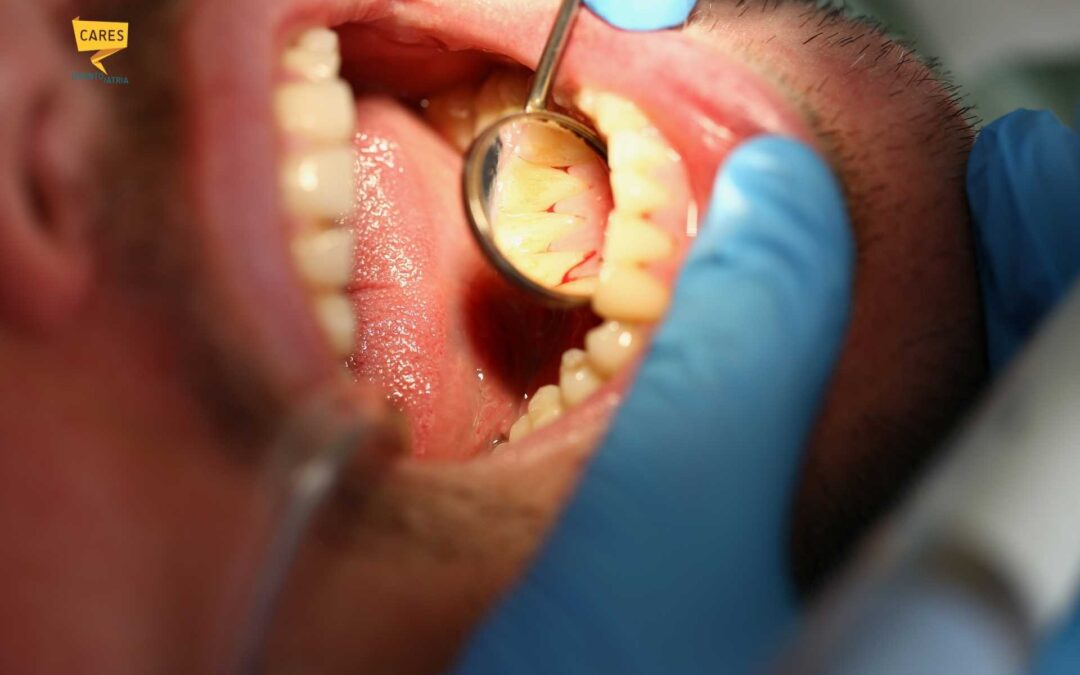 Malattia Parodontale: sintomi, cause e cure