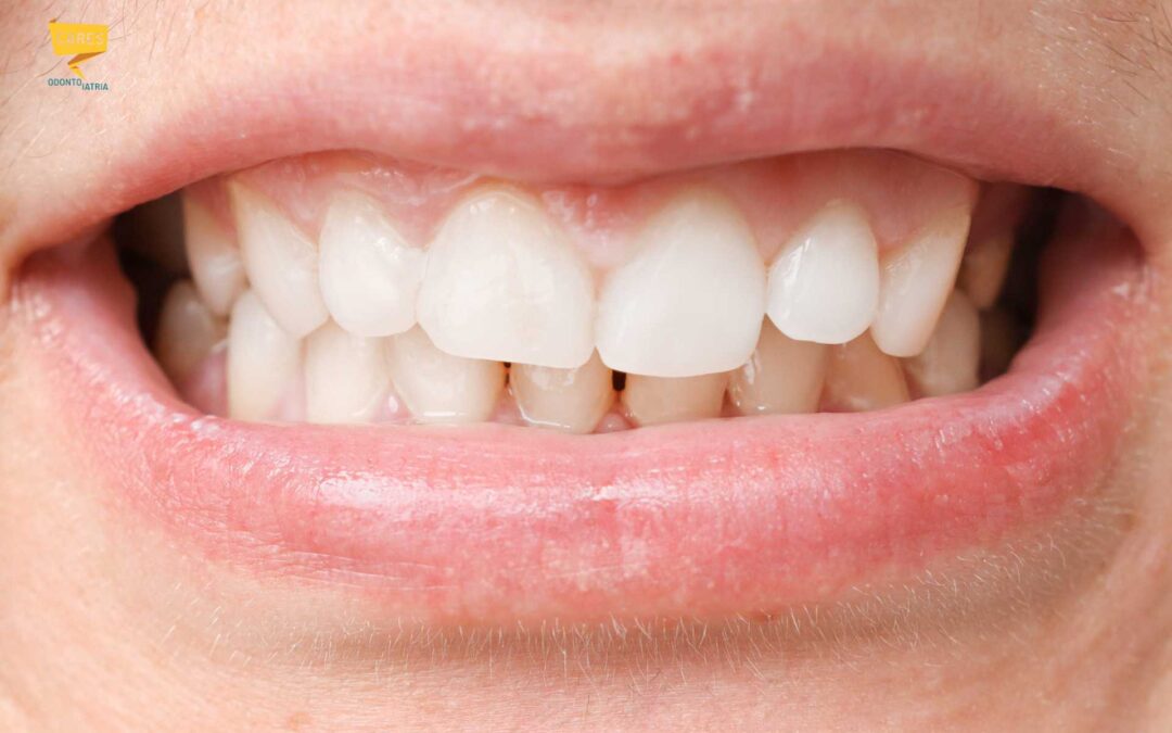 Malocclusione dentale: cos’è, sintomi e come curarla