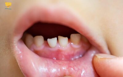 Denti da latte… perchè curarli?