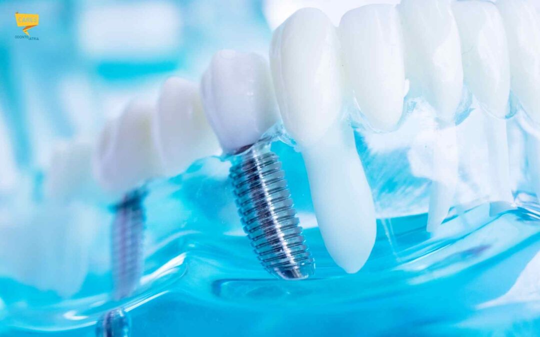 Implantologia: chi soffre di parodontite può fare impianti dentali?