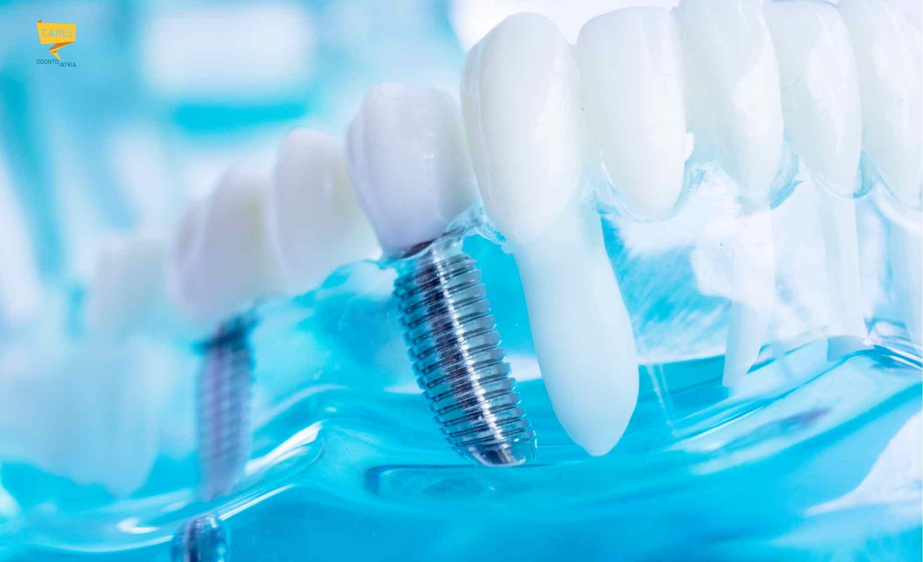 Implantologia dentale con impianto dentale inserito nell’osso e protesi che sostituisce i denti naturali