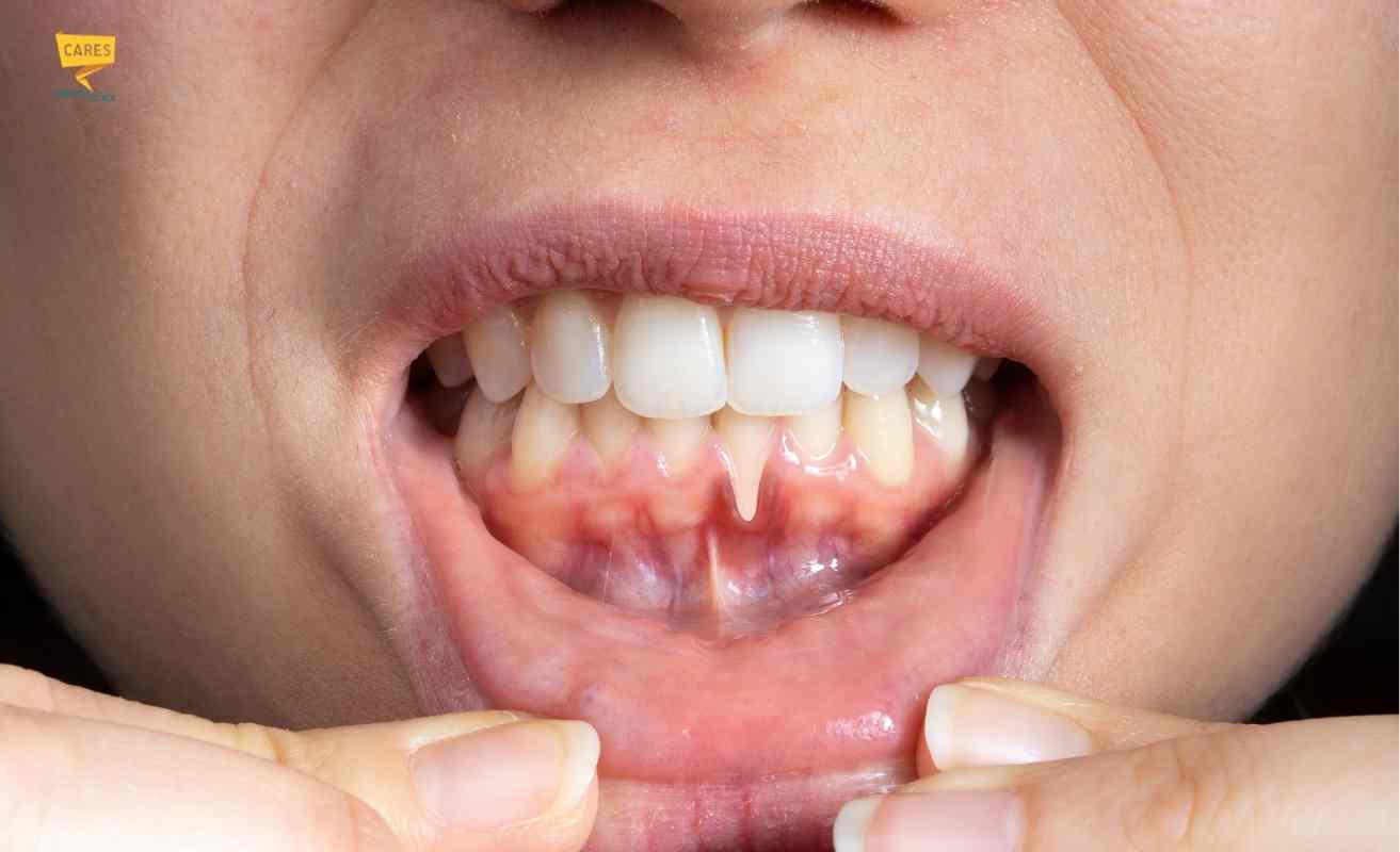 gengive che si ritirano con esposizione delle radici dentali e segni di retrazione gengivale